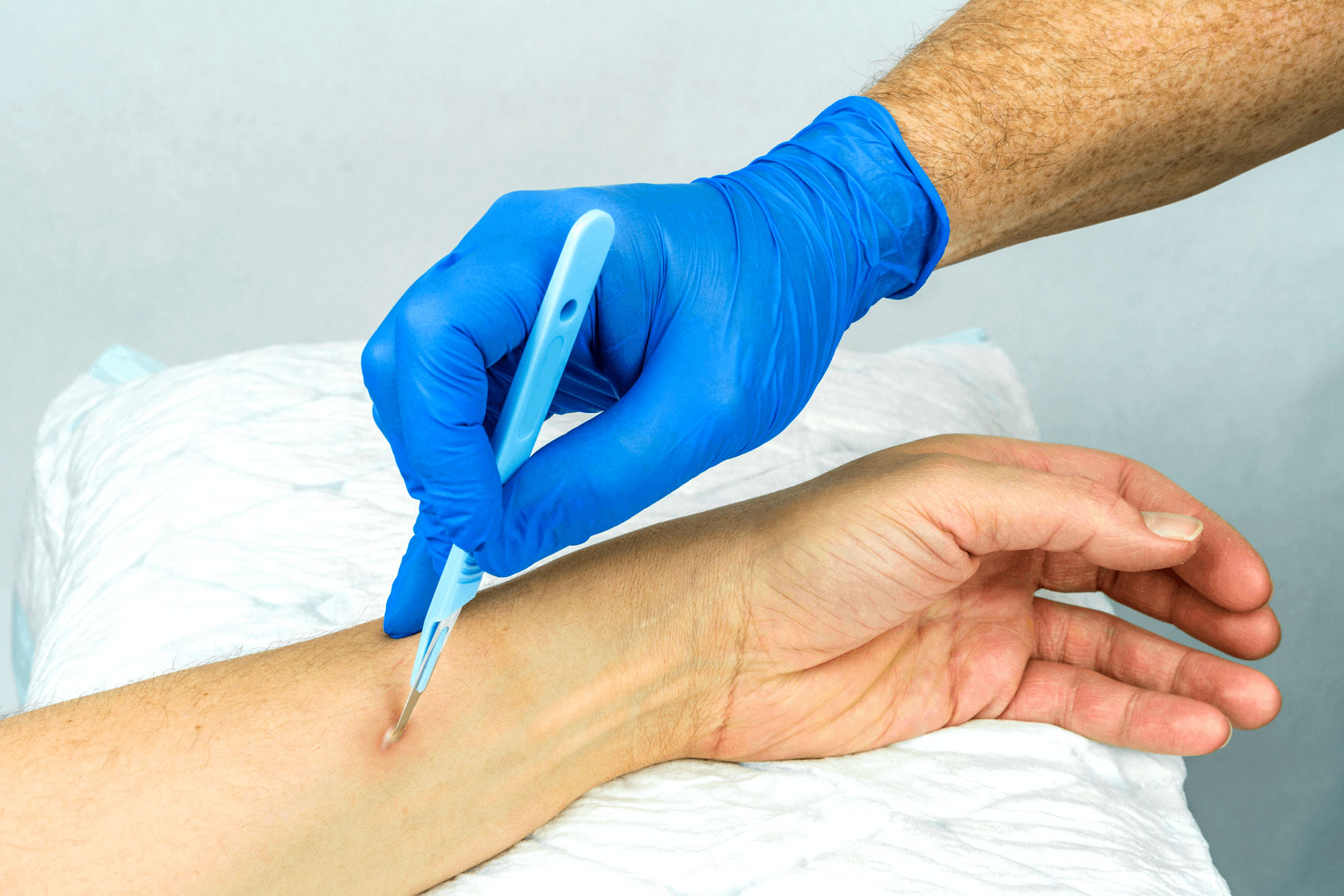 Abscess – Blue Water Urgent Care – Algonac